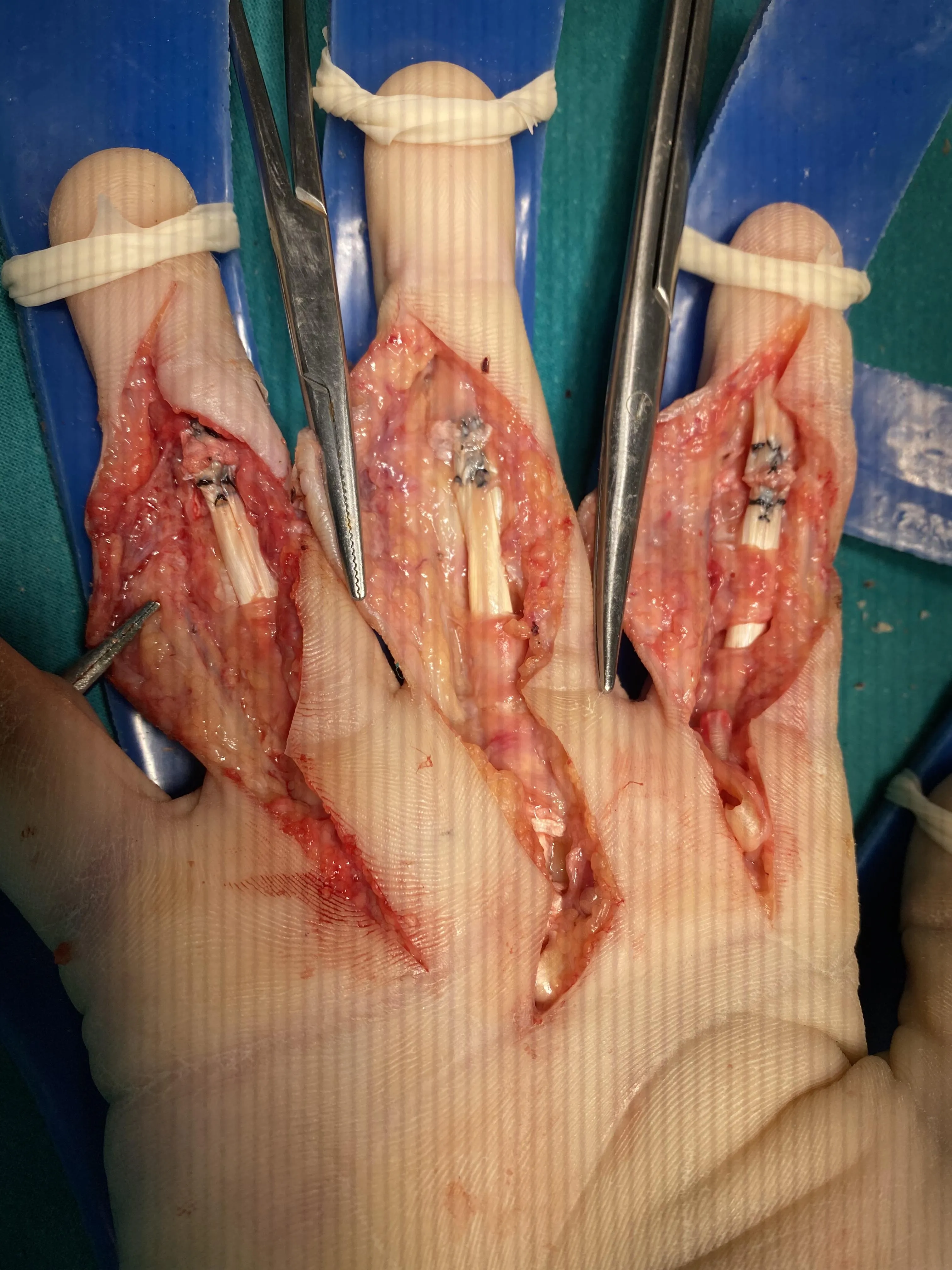 Сшивание сухожилий